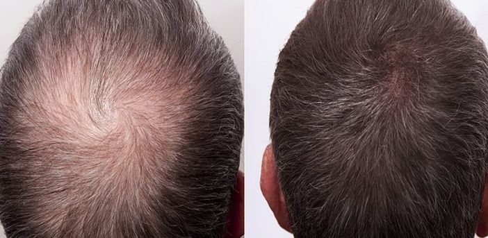 Diradamento Capelli, cause e come si risolve