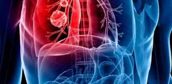 Mesotelioma Mesotelioma