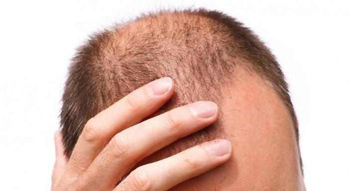 Oggi la calvizie si sconfigge all’estero