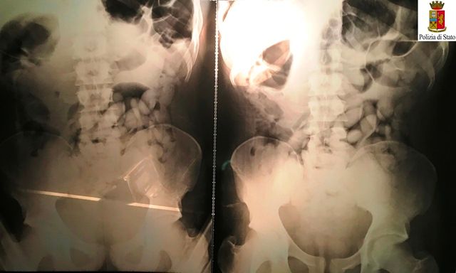 Ovuli ingeriti da un body stuffer per sottrarsi all'arresto