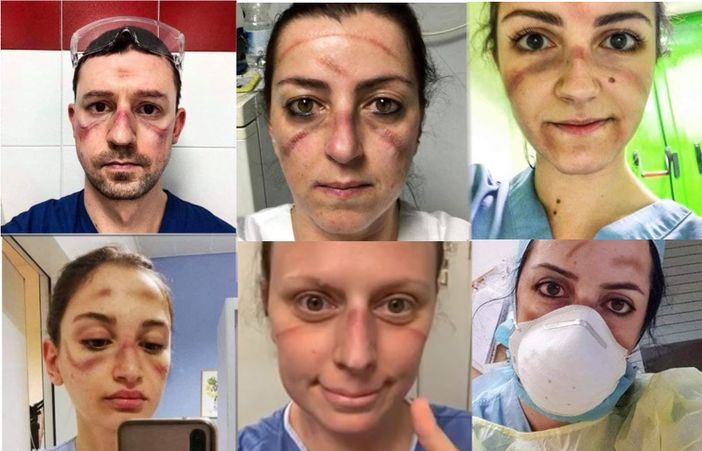 Coronavirus, infermieri Nursing Up: "Il Governo stanzi risorse per chi è in trincea da oltre un mese"