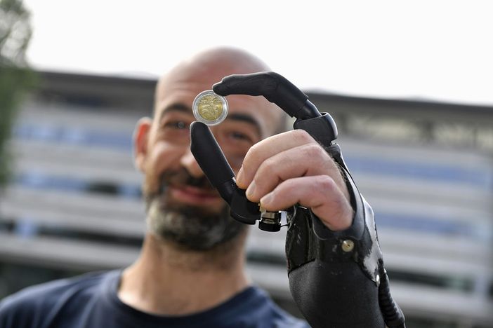 Operaio operato a Torino riacquista la funzionalità della mano sinistra con una protesi bionica [FOTO E VIDEO]