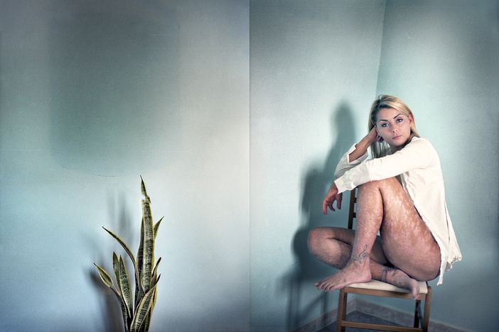 Domani a Torino flashmob e scatti d'autore contro la psoriasi Domani a Torino flashmob e scatti d'autore contro la psoriasi