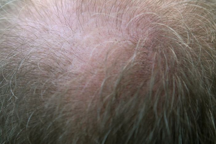 Trapianti di capelli: il miglior costo per un super risultato Trapianti di capelli: il miglior costo per un super risultato