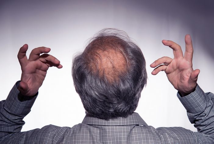 La Calvizie e l'Emotività: Il Trapianto di Capelli come Soluzione Ottimale La Calvizie e l'Emotività: Il Trapianto di Capelli come Soluzione Ottimale