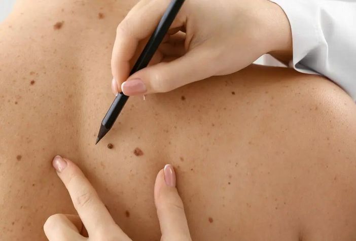 Prevenzione del melanoma: perché iniziare fin da bambini Prevenzione del melanoma: perché iniziare fin da bambini
