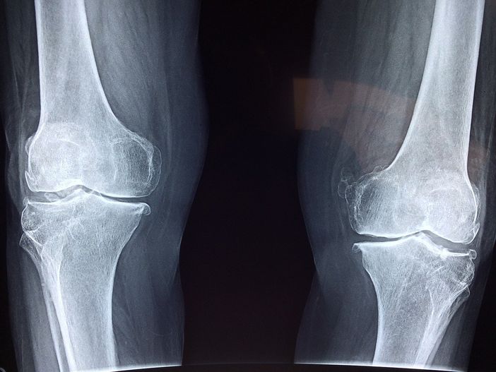 Beneficio della magnetoterapia per il trattamento dell'osteoartrosi e di altre malattie Cos'è l'artrosi? Beneficio della magnetoterapia per il trattamento dell'osteoartrosi e di altre malattie Cos'è l'artrosi?