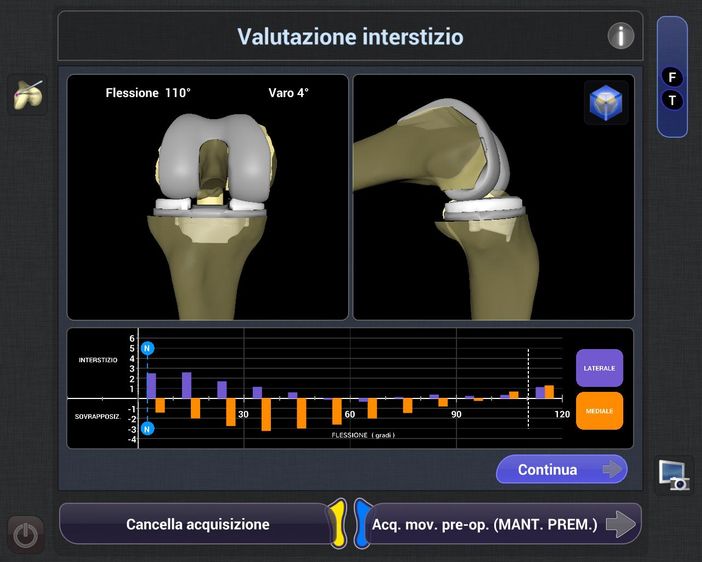 Cto, per la prima volta in Italia eseguito con un robot un impianto di protesi di ginocchio anatomica con risparmio dei crociati