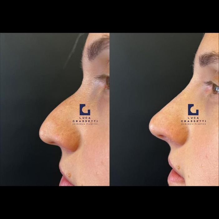 Cos’è il Rinofilling, anche detto Rino-Lipofilling? Cos’è il Rinofilling, anche detto Rino-Lipofilling?