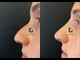Cos’è il Rinofilling, anche detto Rino-Lipofilling?