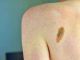 L'oncologo Ascierto: &quot;Aumentano casi melanoma, lampade abbronzanti come fumo&quot;
