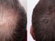 Diradamento Capelli, cause e come si risolve