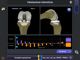 Cto, per la prima volta in Italia eseguito con un robot un impianto di protesi di ginocchio anatomica con risparmio dei crociati