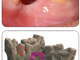Problemi dentali? Da Beldent puoi provare una nuova tecnica di rigenerazione ossea che ti potrebbe davvero migliorare la vita!
