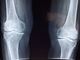 Beneficio della magnetoterapia per il trattamento dell'osteoartrosi e di altre malattie Cos'è l'artrosi?