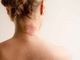 Torna l'open day sulla dermatite atopica