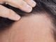 Alopecia, oggi si può agire concretamente