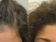 La testimonianza di Giada sul trapianto capelli con Istituto Helvetico Sanders