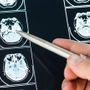 Intelligenza Artificiale può prevedere evoluzione Parkinson, lo studio italiano