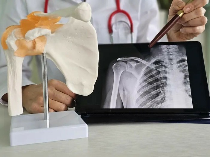 Latarjet artroscopica: cos’è, quando serve, tempi di recupero