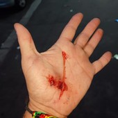 mano ferita