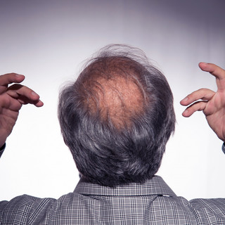 La Calvizie e l'Emotività: Il Trapianto di Capelli come Soluzione Ottimale