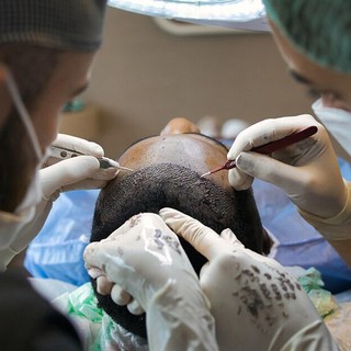 Le Migliori Cliniche per il Trapianto di Capelli in Turchia da Conoscere nel 2025