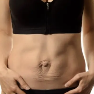 Cos’è una diastasi e perché si manifesta