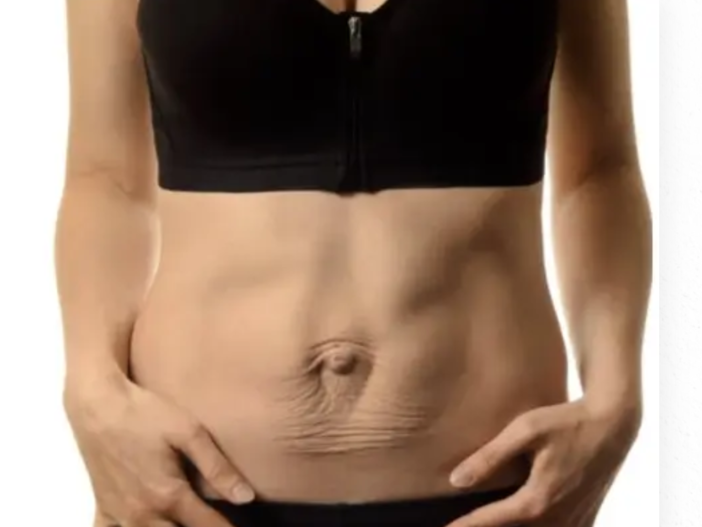 Cos’è una diastasi e perché si manifesta