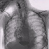 A Torino il 7° Congresso Nazionale della Società Italiana per lo Studio delle Malattie dell’Esofago