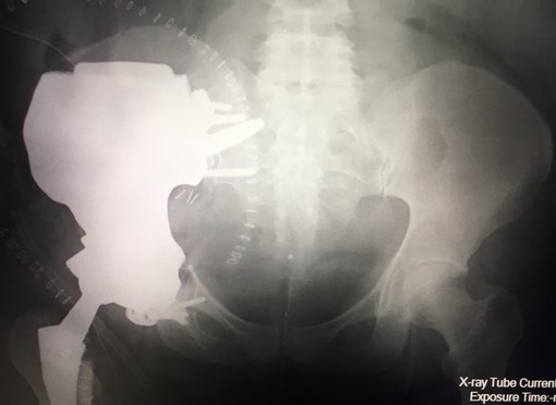Al Cto di Torino intervento chirurgico di ortopedici e ingegneri salva una donna affetta da rarissima forma di sarcoma osseo