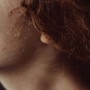 Dermatochirurgia: Come i Trattamenti Chirurgici Possono Migliorare la Tua Pelle