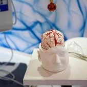 Dai gliomi al Parkinson, così l’intelligenza artificiale aiuta la Neurochirurgia