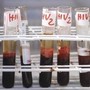 Aids, scoperti 'codici' del sistema immunitario per sospendere le cure