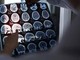 Alzheimer, ok Ue a nuovo farmaco per trattare fasi iniziali malattia