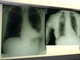 Cancro polmone a piccole cellule, ok Ue a tislelizumab