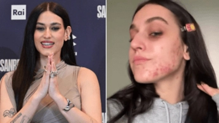 Gaia senza filtri, mostra l'acne sul viso: &quot;Ho pensato di nascondermi, voglio normalizzare&quot;