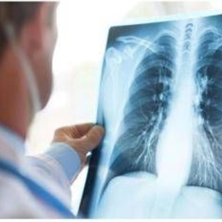 Tumore al polmone a piccole cellule in stadio esteso, ok Aifa a primo anti Pd-1 in prima linea