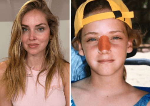 Chiara Ferragni, l'intervento al naso: "Ecco perché è storto ora" Chiara Ferragni, l'intervento al naso: "Ecco perché è storto ora"