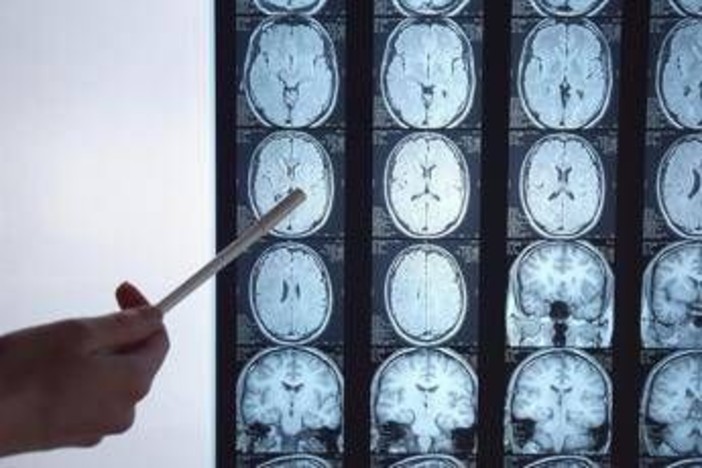 Di Battista e il tumore al cervello, in Italia circa 6mila diagnosi ogni anno: quali sono i sintomi 'spia' Di Battista e il tumore al cervello, in Italia circa 6mila diagnosi ogni anno: quali sono i sintomi 'spia'