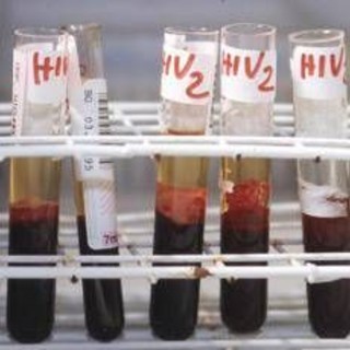 Aids, l'accusa di Bassetti: &quot;Torna a far paura per colpa di Trump&quot;
