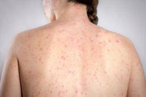 Morbillo, dagli aeroporti Usa alle scuole di Londra: dilagano gli alert Morbillo, dagli aeroporti Usa alle scuole di Londra: dilagano gli alert