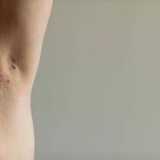 Idrosadenite suppurativa, appello esperti 'sia inserita nel Piano delle cronicità'