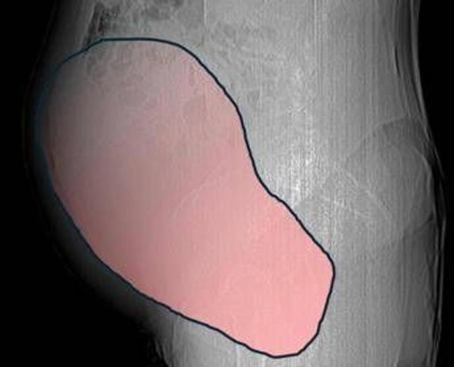 Intervento record al Sant'Anna di Torino, rimosso tumore ovarico di 6 kg Intervento record al Sant'Anna di Torino, rimosso tumore ovarico di 6 kg