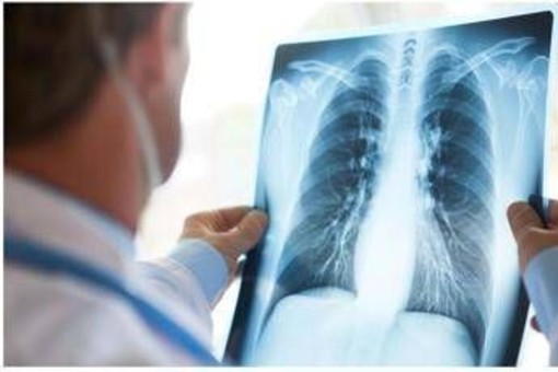 Cancro polmone Egfr-mutato, studio fase 3 Adaura: "Il 79% dei pazienti vivo a 8 anni con Osimertinib"