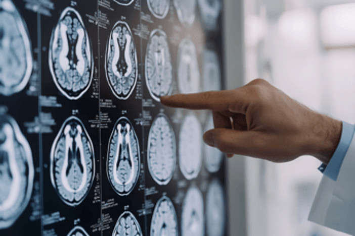 Tumori: glioma, Fda riconosce come farmaco orfano l'isotopo rame-64 sviluppato nelle Marche Tumori: glioma, Fda riconosce come farmaco orfano l'isotopo rame-64 sviluppato nelle Marche