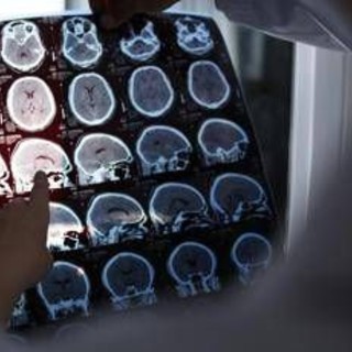 Alzheimer, ok Ue a nuovo farmaco per trattare fasi iniziali malattia