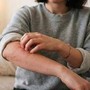 Malattia della pioggia, perché se ne parla: cos'è e sintomi