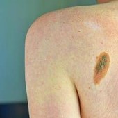 Melanoma, la firma mutazionale del cancro potrà cambiare la cura Melanoma, la firma mutazionale del cancro potrà cambiare la cura