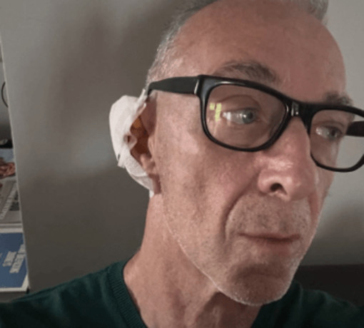 Linus ha una malattia della pelle: "Si chiama Epitelioma". Di cosa si tratta Linus ha una malattia della pelle: "Si chiama Epitelioma". Di cosa si tratta